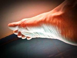 Diabetic_Foot_Pain_Diabetic_feet_Neuropathy_in_feet_Bunion_pain